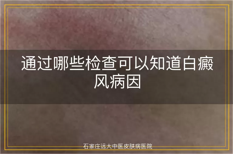 通过哪些检查可以知道白癜风病因
