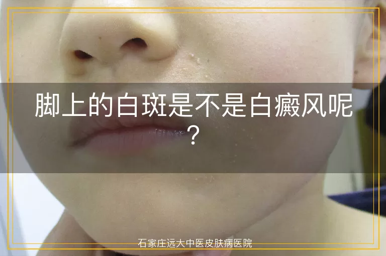 脚上的白斑是不是白癜风呢？