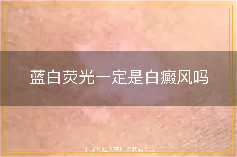 蓝白荧光一定是白癜风吗