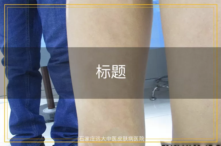 患白癜风的宝宝需要做哪些检查呢