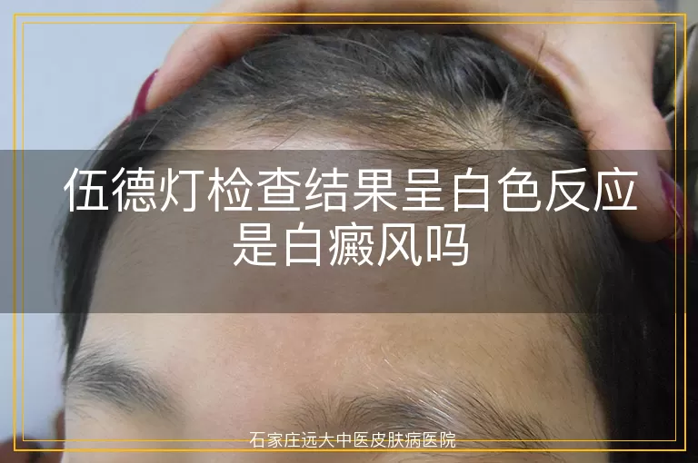 伍德灯检查结果呈白色反应是白癜风吗