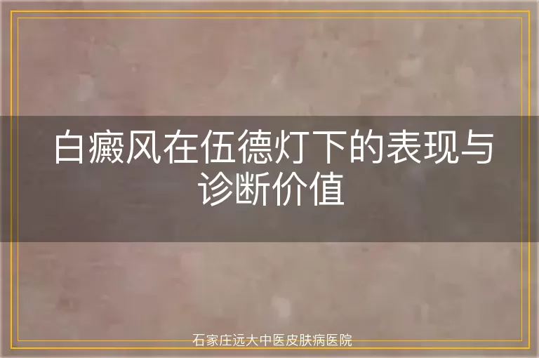 白癜风在伍德灯下的表现与诊断价值