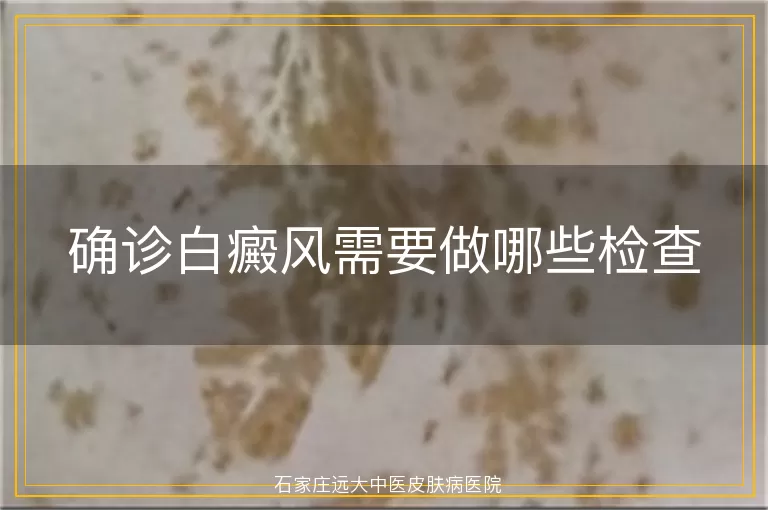 确诊白癜风需要做哪些检查