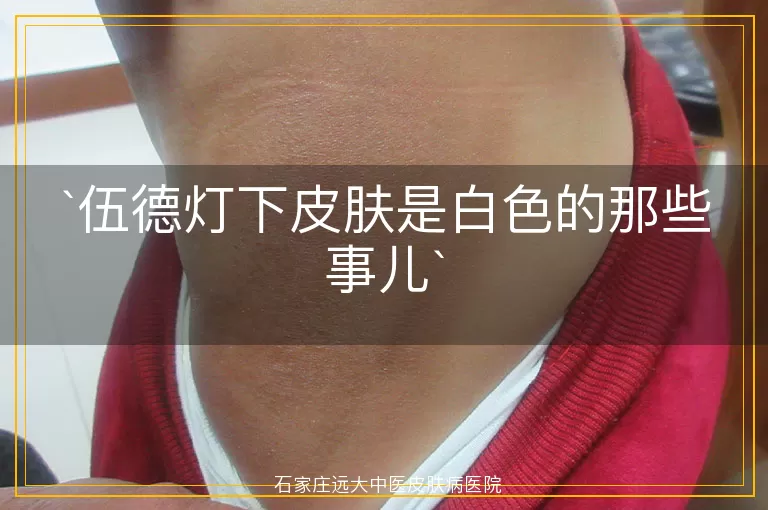 伍德灯下皮肤是白色的那些事儿