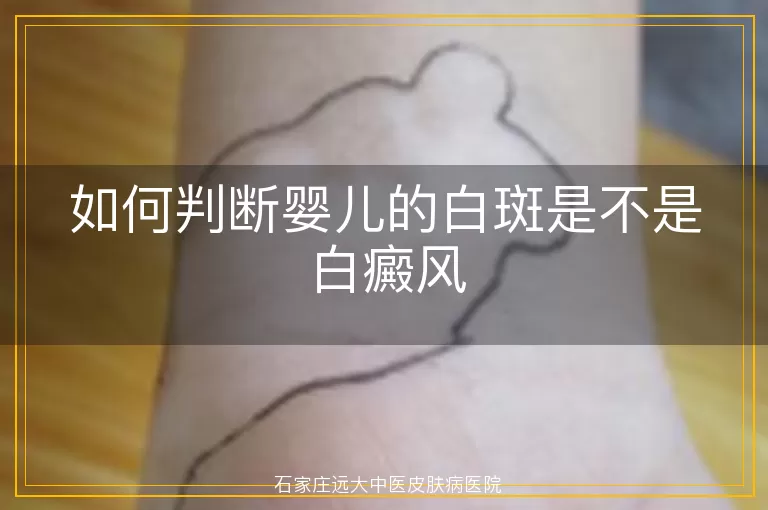 如何判断婴儿的白斑是不是白癜风