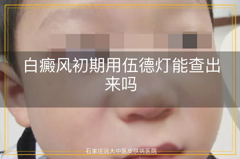 白癜风初期用伍德灯能查出来吗