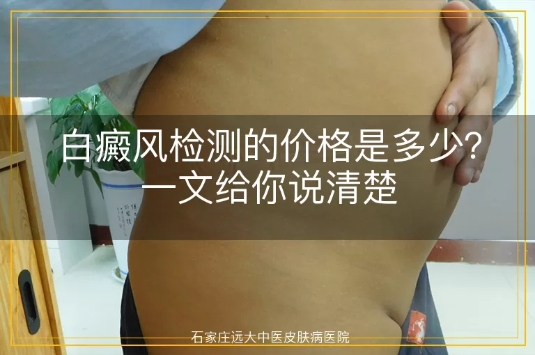 白癜风检测的价格是多少?一文给你说清楚