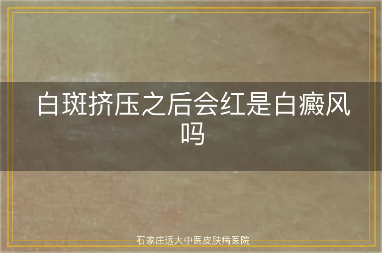 白斑挤压之后会红是白癜风吗