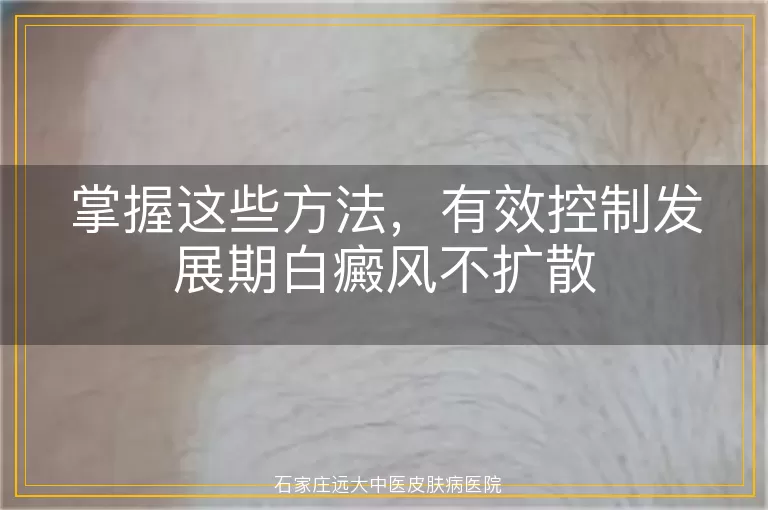掌握这些方法，有效控制发展期白癜风不扩散