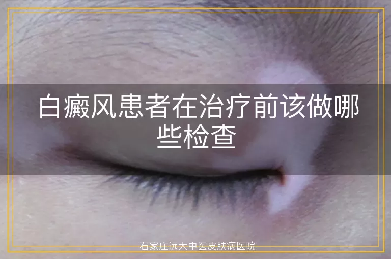 白癜风患者在治疗前该做哪些检查