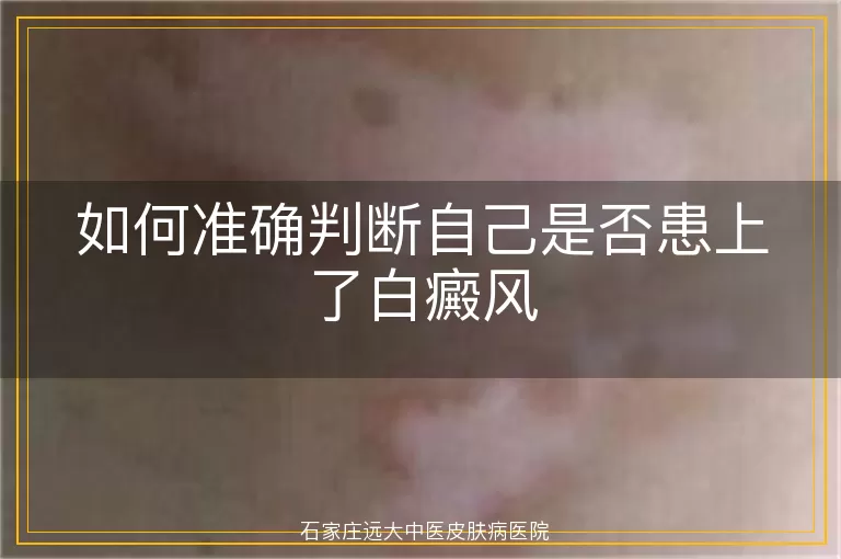 如何准确判断自己是否患上了白癜风