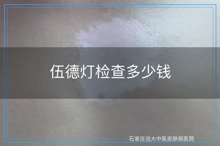 伍德灯检查多少钱