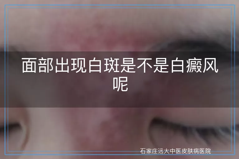面部出现白斑是不是白癜风呢