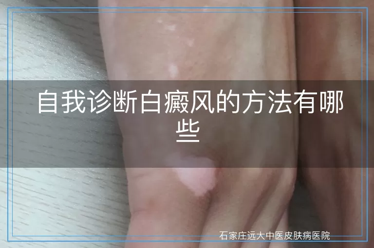 自我诊断白癜风的方法有哪些