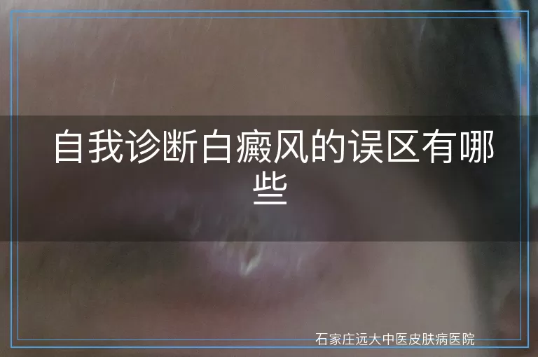 自我诊断白癜风的误区有哪些