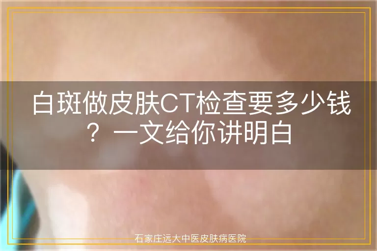 白斑做皮肤CT检查要多少钱？一文给你讲明白