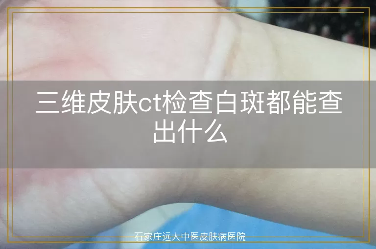 三维皮肤ct检查白斑都能查出什么