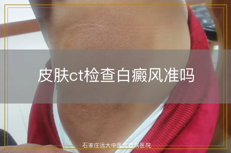 皮肤ct检查白癜风准吗