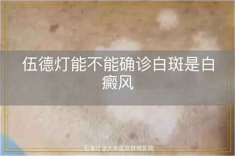 伍德灯能不能确诊白斑是白癜风