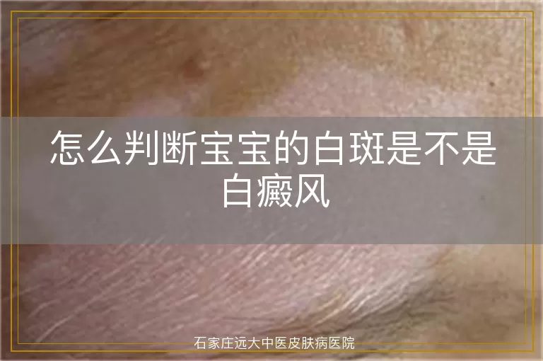 怎么判断宝宝的白斑是不是白癜风