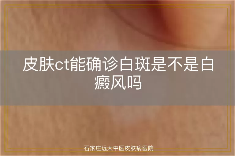 皮肤ct能确诊白斑是不是白癜风吗