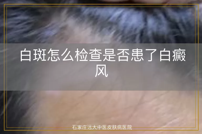 白斑怎么检查是否患了白癜风
