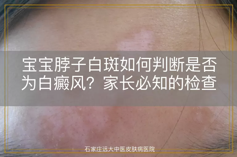 宝宝脖子白斑如何判断是否为白癜风？家长必知的检查方法