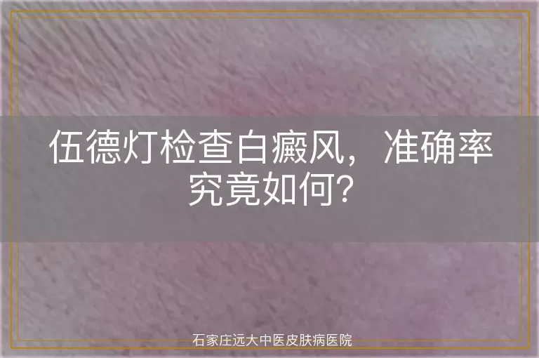 伍德灯检查白癜风，准确率究竟如何？