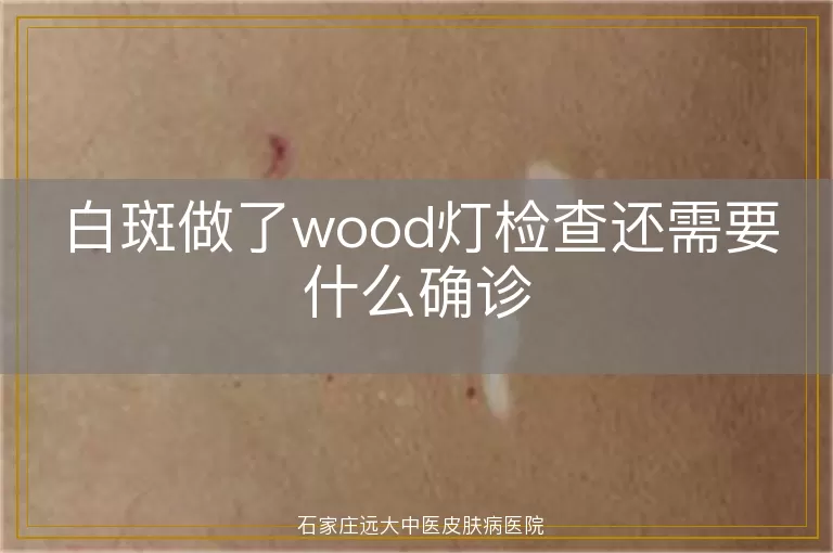 白斑做了wood灯检查还需要什么确诊