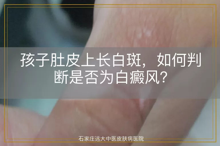 孩子肚皮上长白斑，如何判断是否为白癜风？
