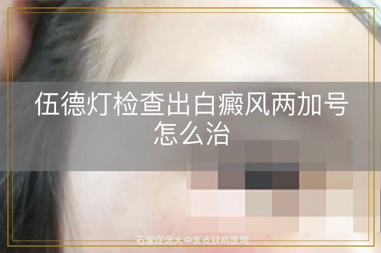 伍德灯检查出白癜风两加号怎么治