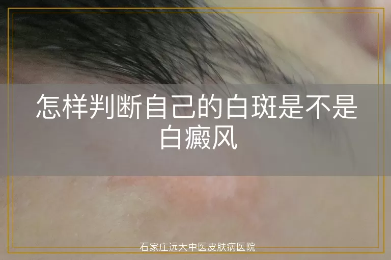 怎样判断自己的白斑是不是白癜风
