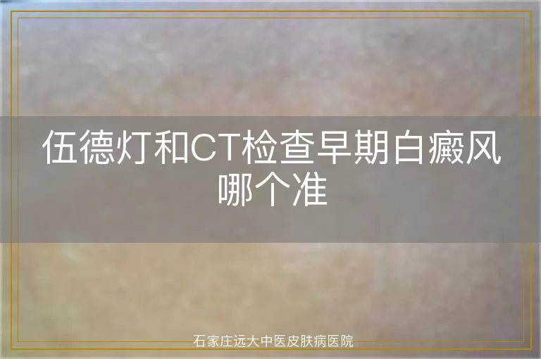 伍德灯和CT检查早期白癜风哪个准
