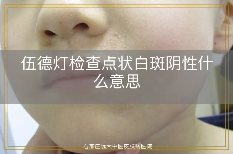 伍德灯检查点状白斑阴性什么意思