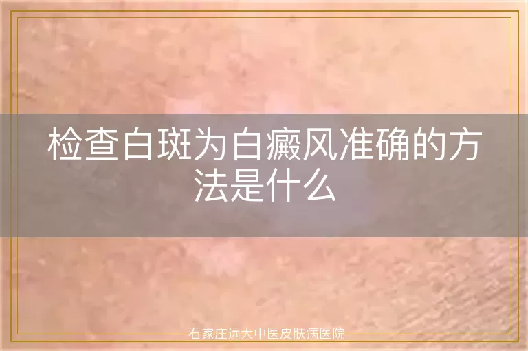 检查白斑为白癜风准确的方法是什么