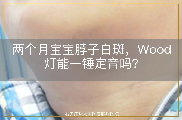 两个月宝宝脖子白斑，Wood灯能一锤定音吗？