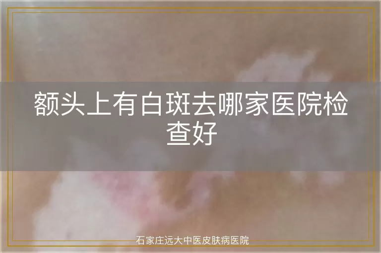 额头上有白斑去哪家医院检查好