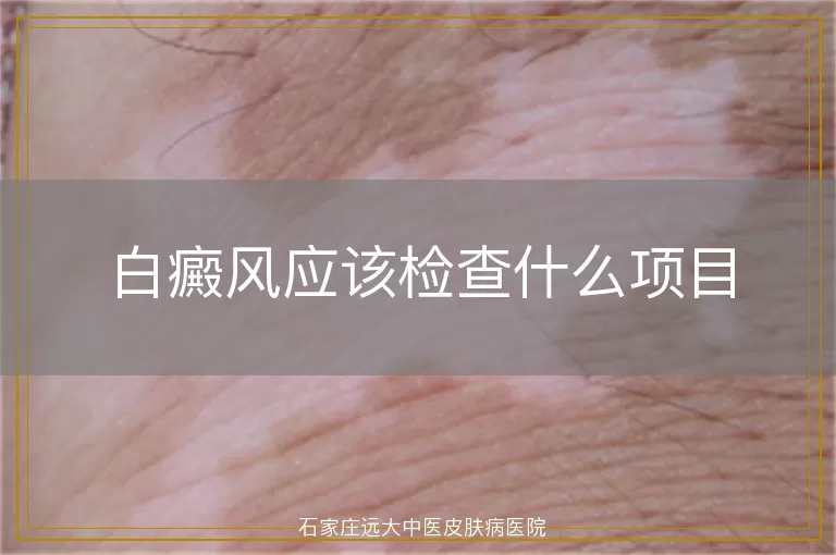 白癜风应该检查什么项目