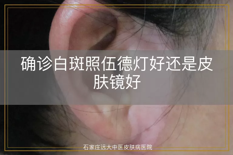 确诊白斑照伍德灯好还是皮肤镜好