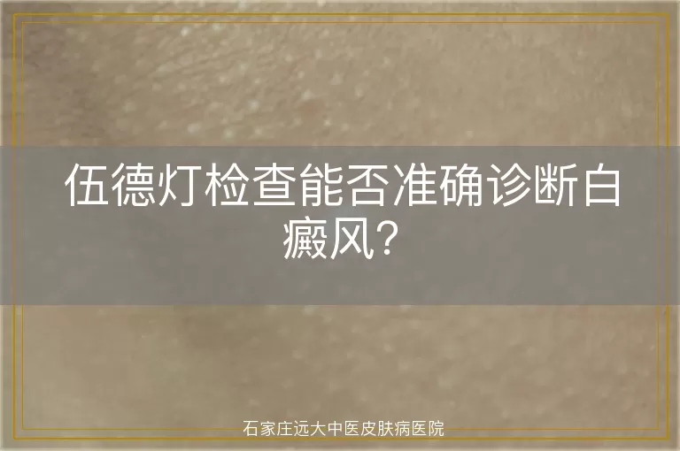 伍德灯检查能否准确诊断白癜风？