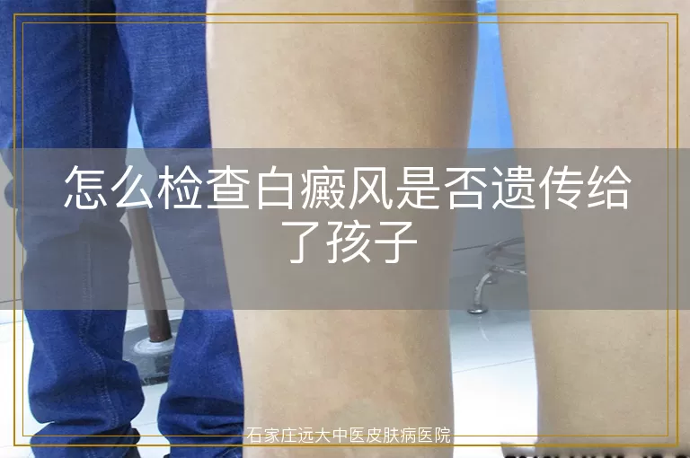 怎么检查白癜风是否遗传给了孩子