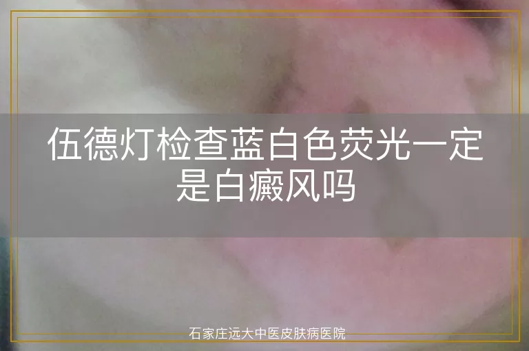 伍德灯检查蓝白色荧光一定是白癜风吗