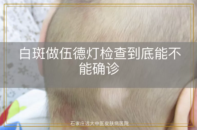 白斑做伍德灯检查到底能不能确诊