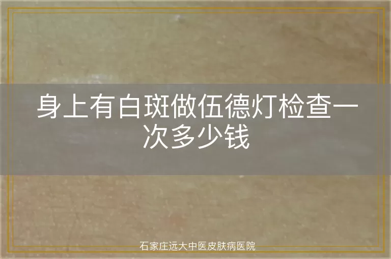 身上有白斑做伍德灯检查一次多少钱
