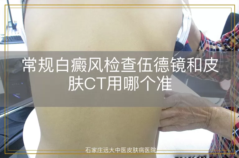 常规白癜风检查伍德镜和皮肤CT用哪个准