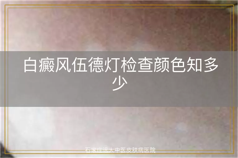 白癜风伍德灯检查颜色知多少