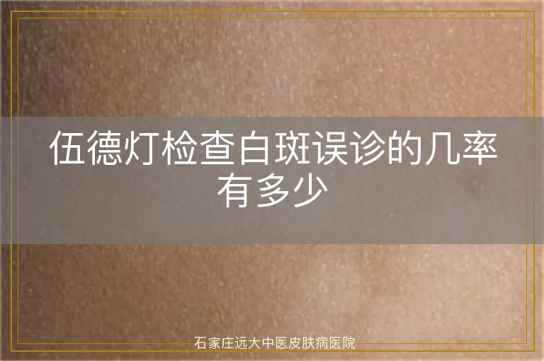 伍德灯检查白斑误诊的几率有多少