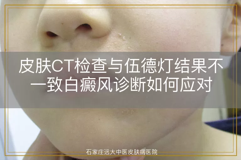 皮肤CT检查与伍德灯结果不一致白癜风诊断如何应对