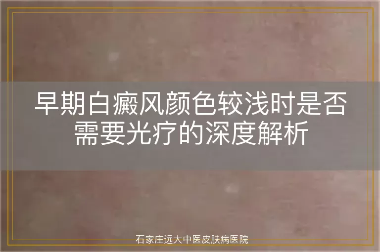 早期白癜风颜色较浅时是否需要光疗的深度解析