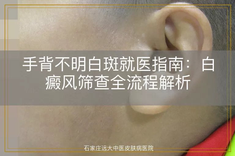 手背不明白斑就医指南：白癜风筛查全流程解析